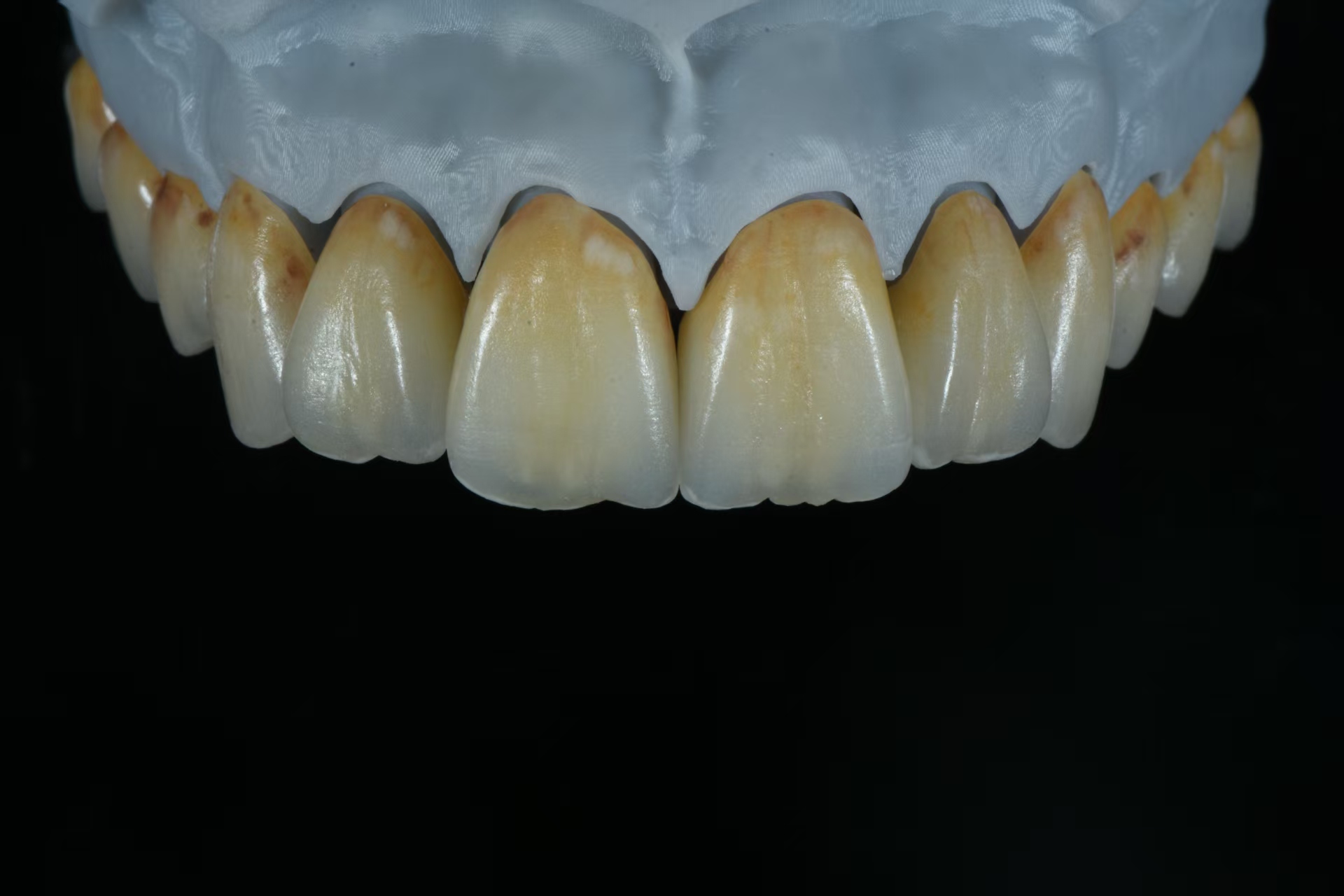 Prosthetics