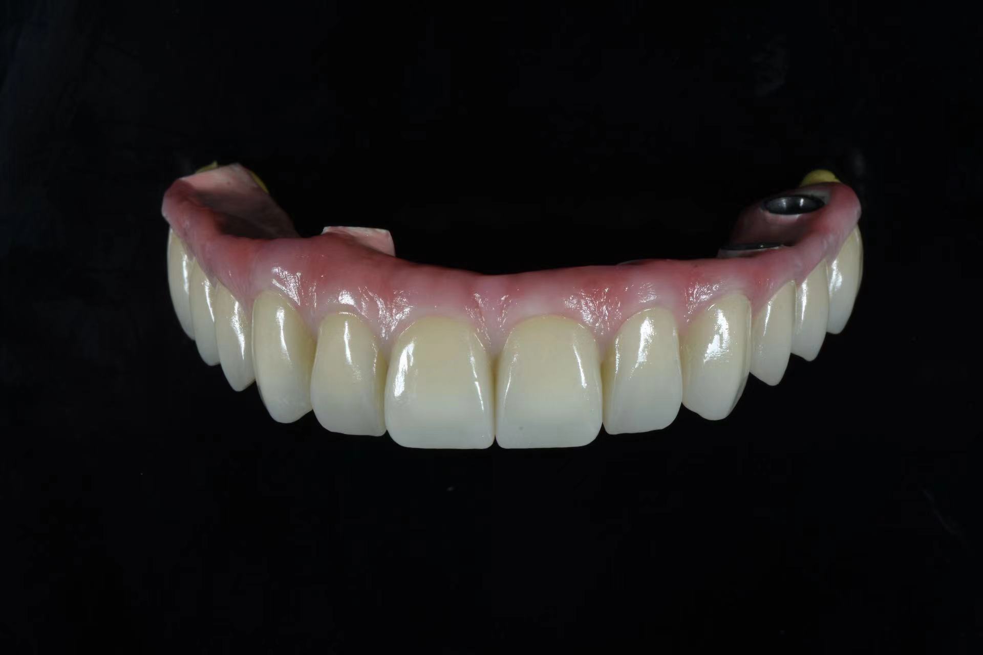 Digital Dentures